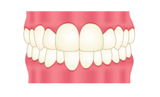 八重歯 歯並びの改善 デンティナ